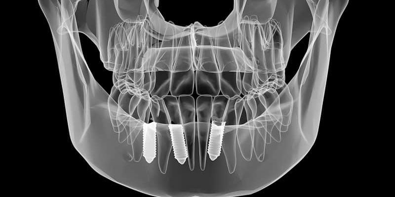 chirurgiczne usuwanie zębów warszawa