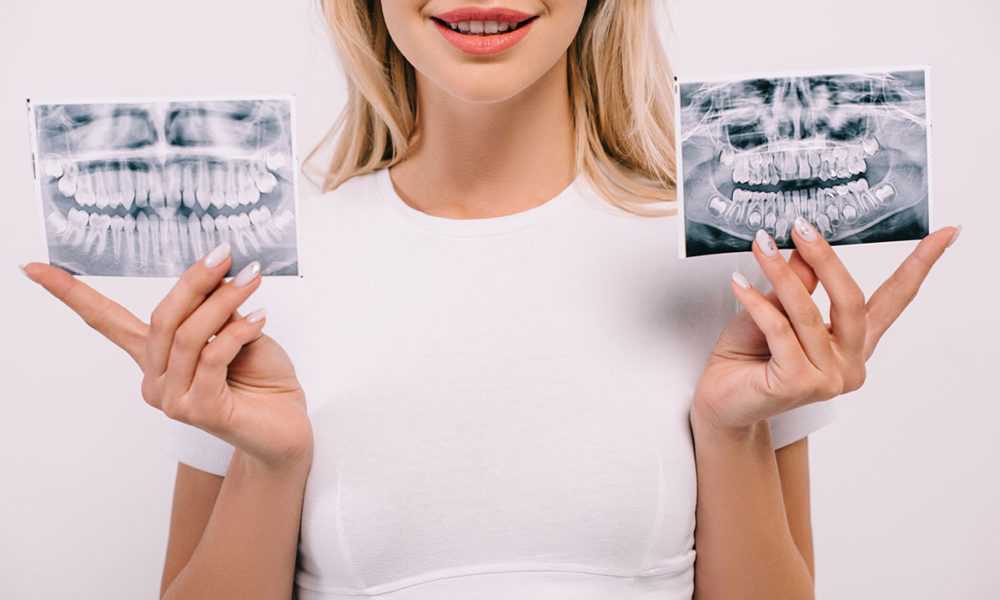 prześwietlenie zęba warszawa